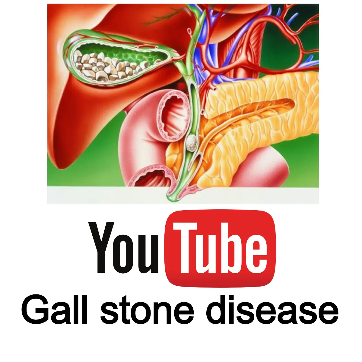 Gall stone disease